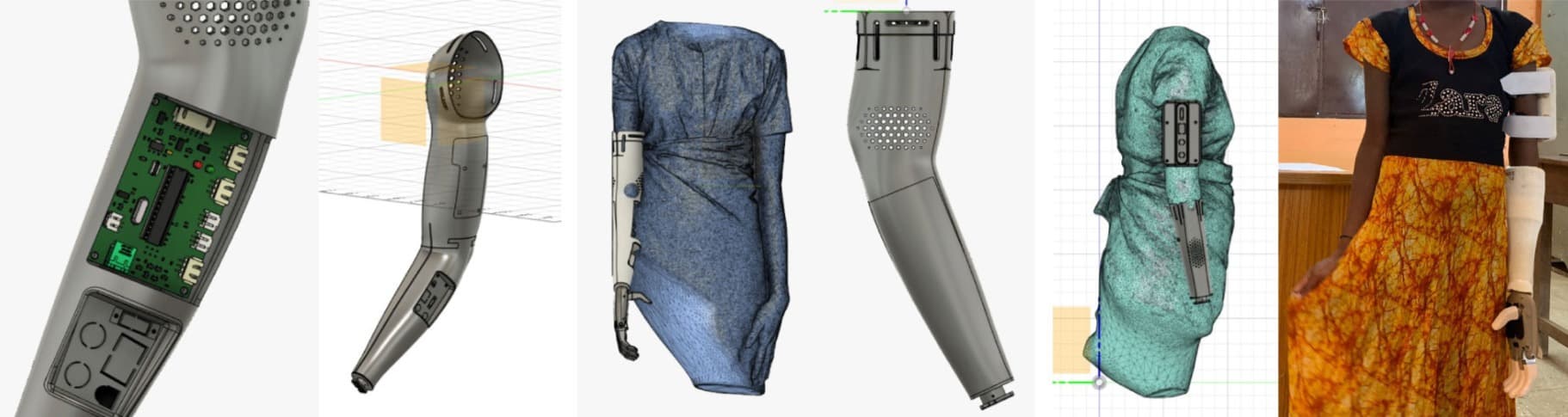 Three types of amputations and their respective socket design - Through Shoulder Amputation, Above Elbow Amputation, Below Elbow Amputation